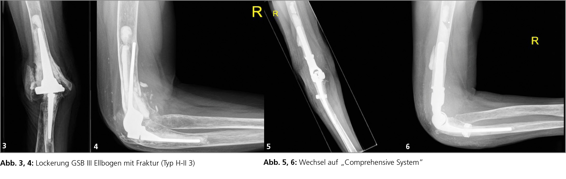 Revision des Ellenbogens  eine besondere Herausforderung - Orthopdie &  Traumatologie - Universimed - Knowledge that matters