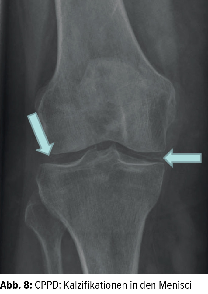 Das Schmerzhaft Geschwollene Gelenk Orthopadie Traumatologie Universimed Medizin Im Fokus