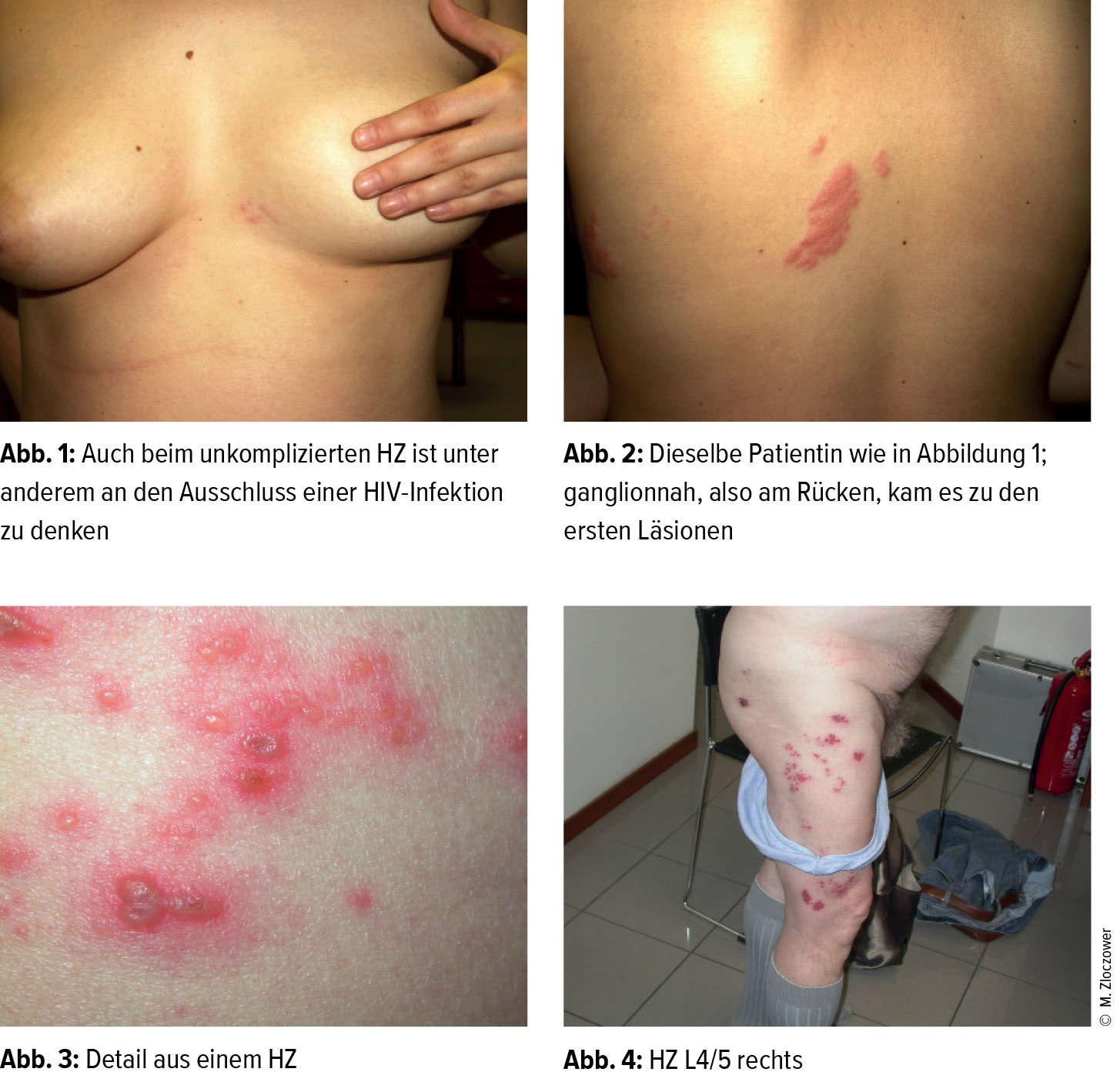 Herpes Zoster Im Uberblick Allgemeinmedizin Universimed Medizin Im Fokus