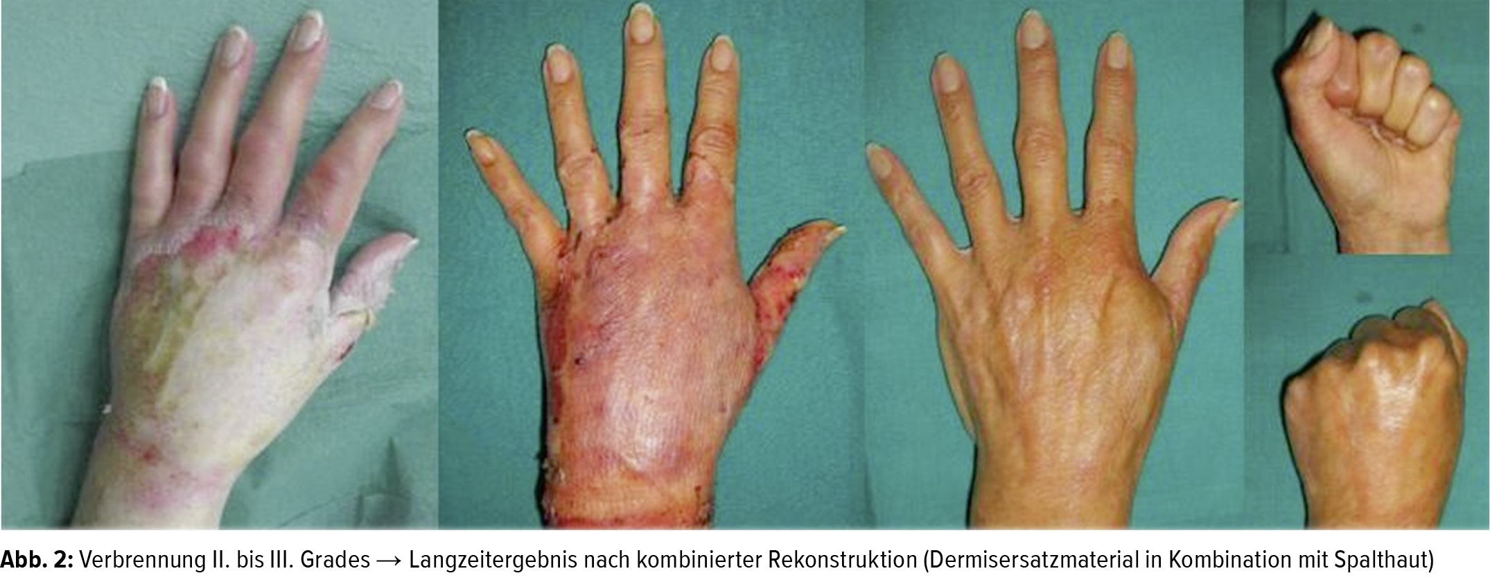 Die Behandlung Von Brandverletzten Ein Update Plastische Chirurgie Universimed Medizin Im Fokus