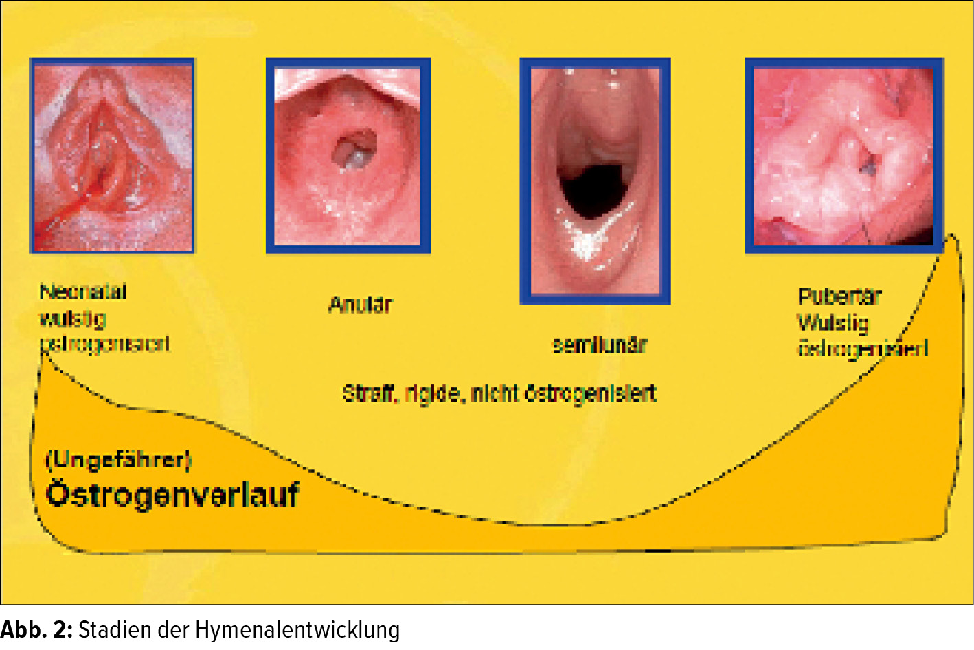 Wie sieht das jungfernhäutchen aus wenn es gerissen ist