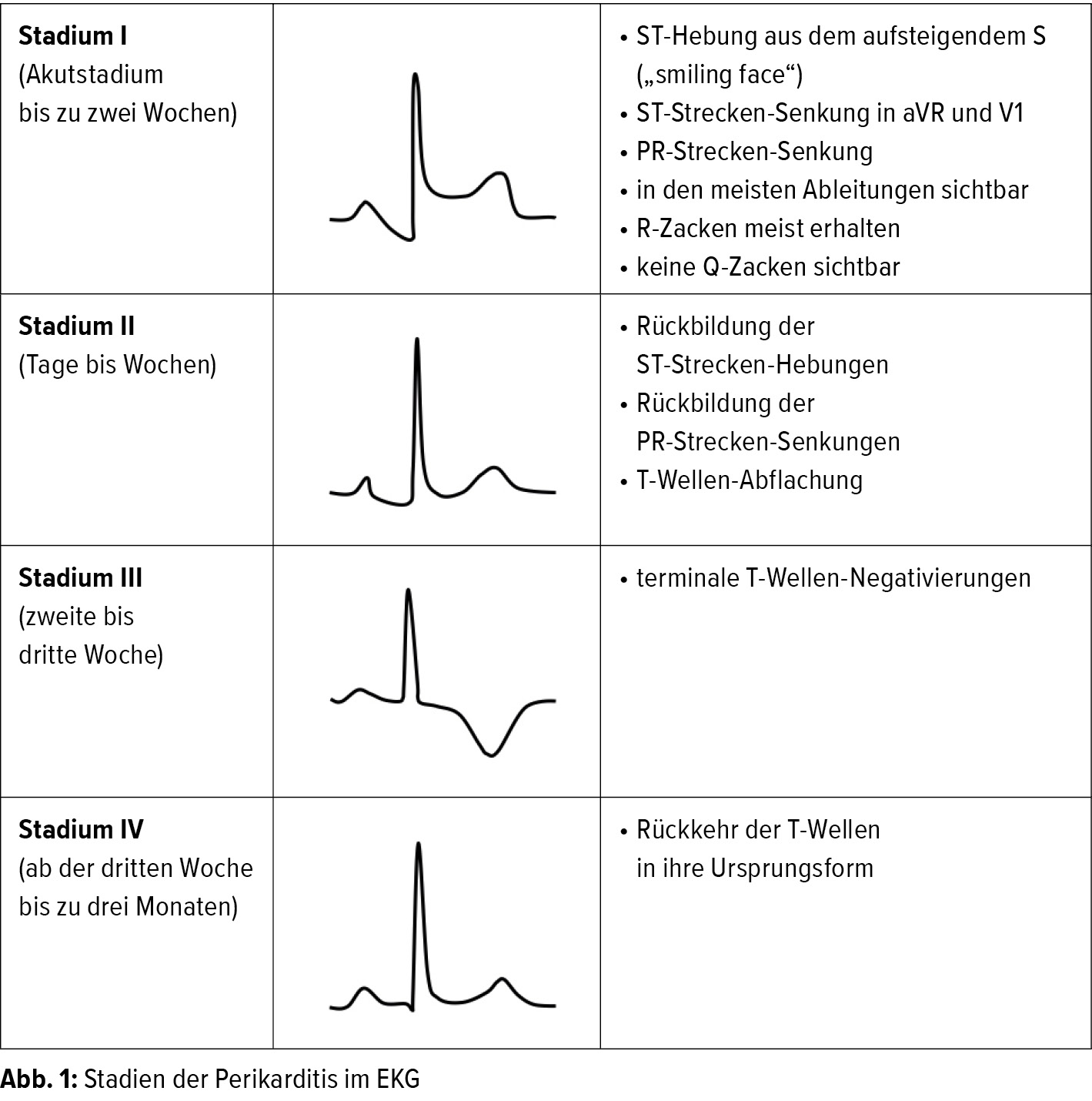 Die Perikarditis Im Ekg Abgrenzung Zum Myokardinfarkt Kardiologie Gefassmedizin Universimed Medizin Im Fokus