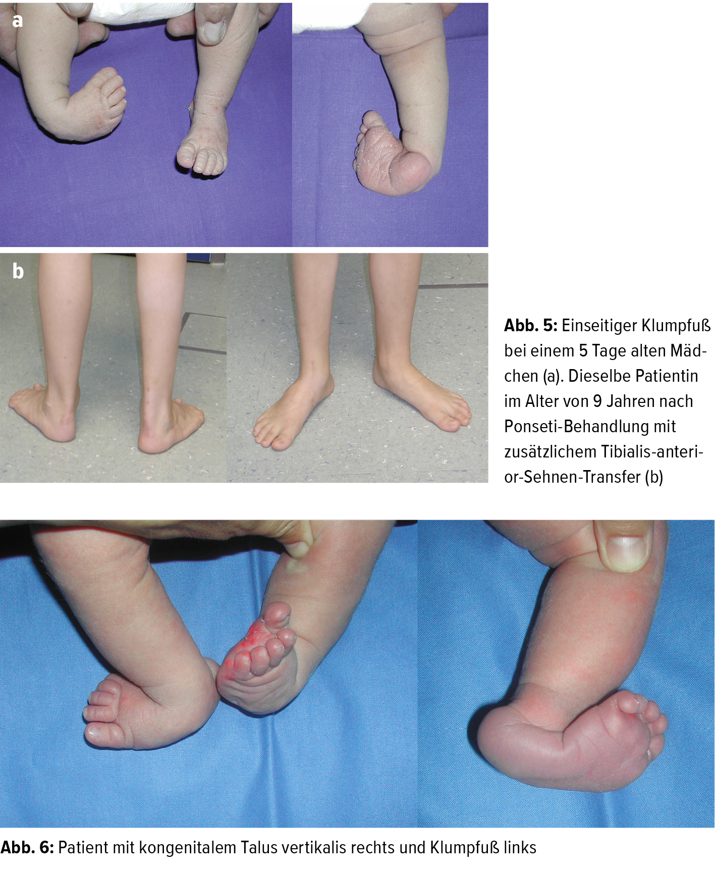 Fehlbildungen Des Sauglingsfusses Orthopadie Traumatologie Universimed Medizin Im Fokus