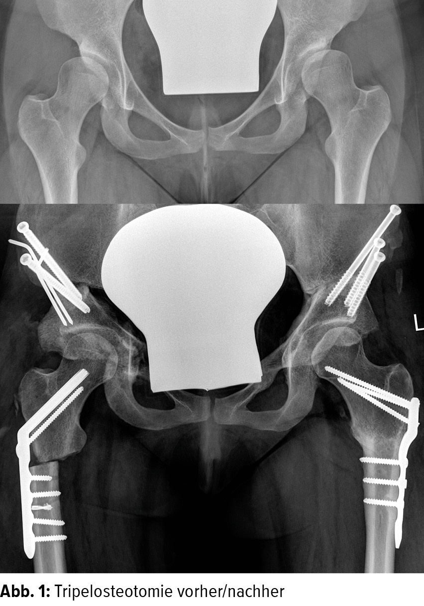 HüftTEP oder doch noch Rekonstruktion? Orthopädie & Traumatologie Universimed Medizin im