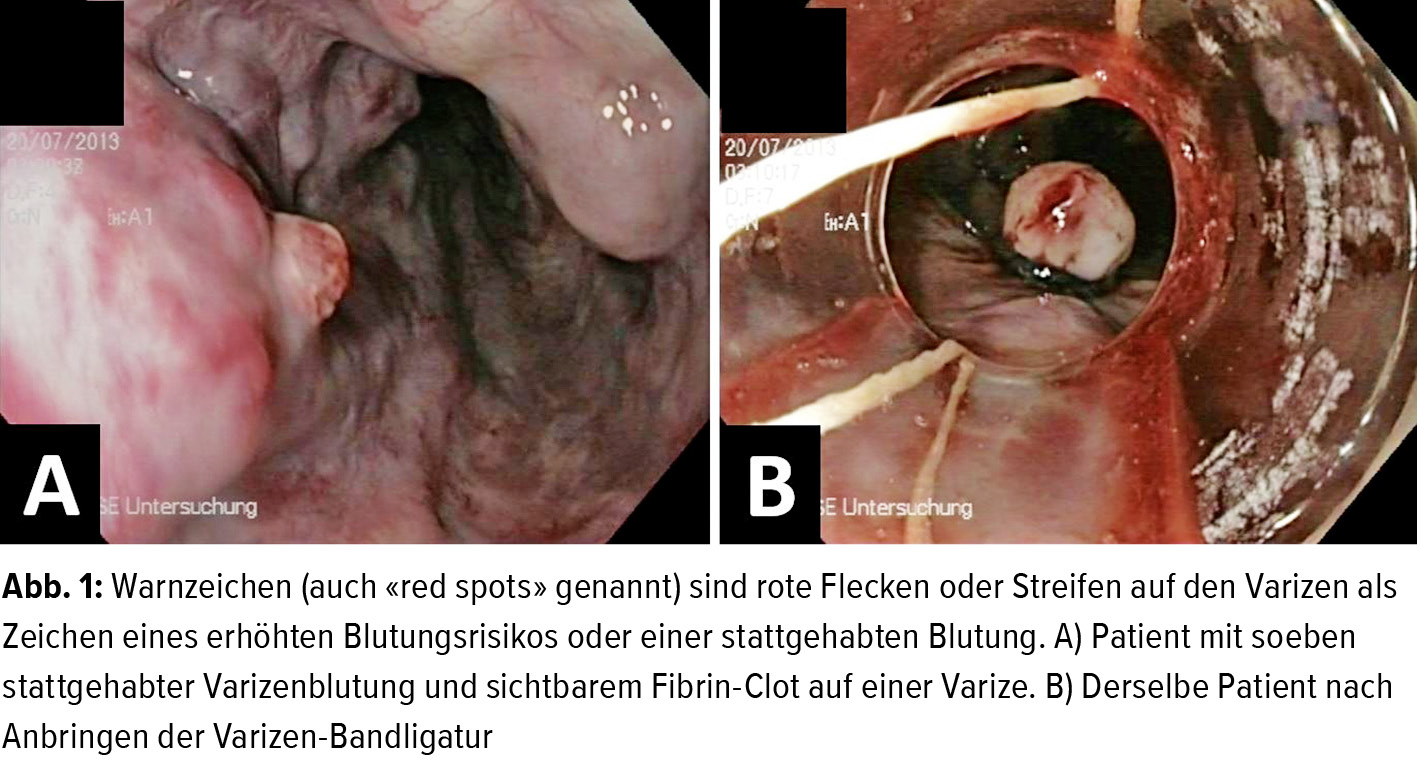 Eine frühere arbeit konnte nach einer endoskopischen varizenbehandlung bei varizenblutung eine passagere portaldruckerhöhung auch 5 tage nach der blutung messen. Varizenblutung : Update Varizenblutung Gastroenterologie Universimed Medizin Im Fokus