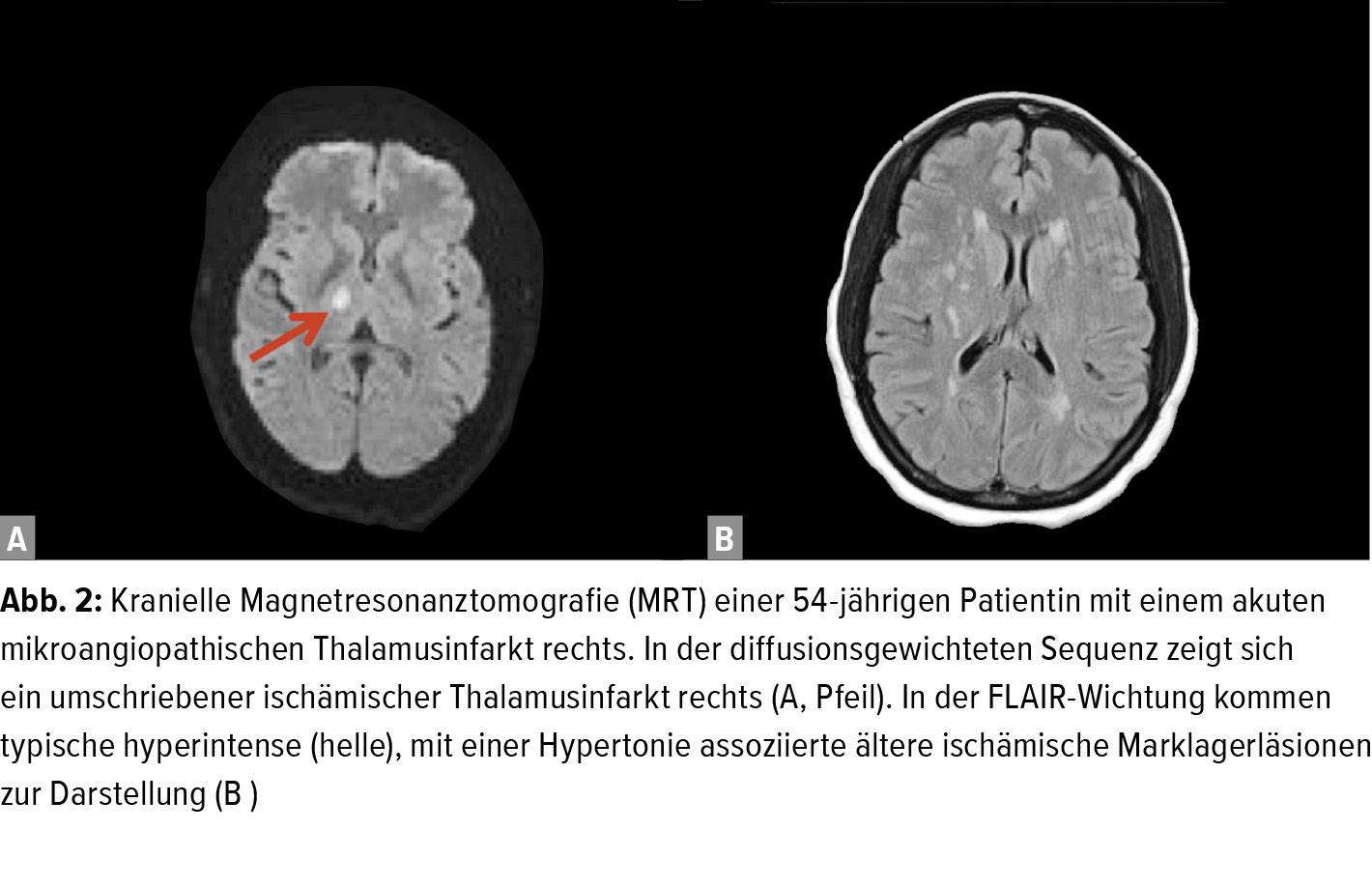 Blutdrucktherapie Beim Akuten Schlaganfall Kardiologie Gefassmedizin Universimed Medizin Im Fokus