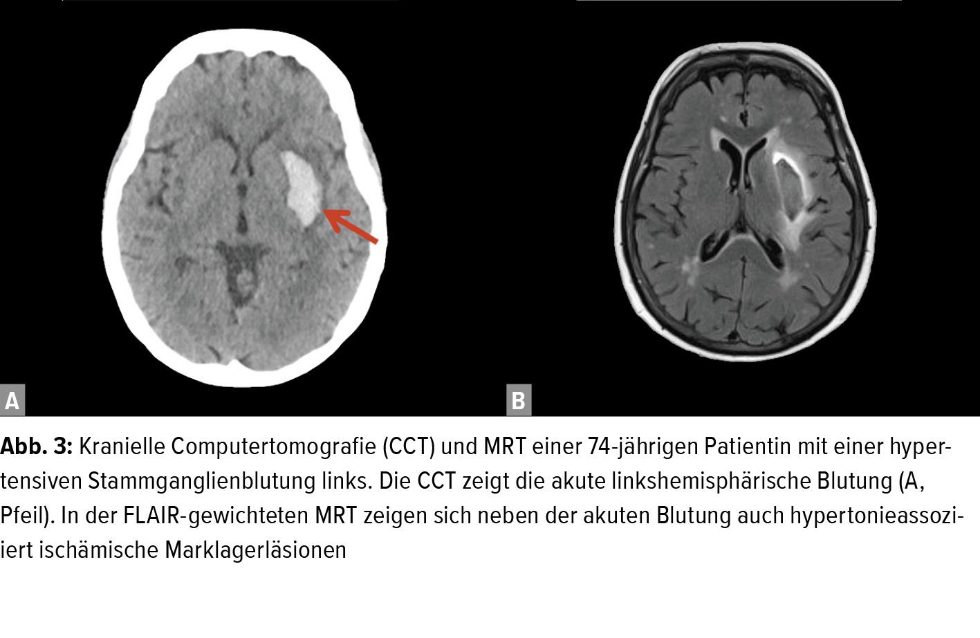 Blutdrucktherapie Beim Akuten Schlaganfall