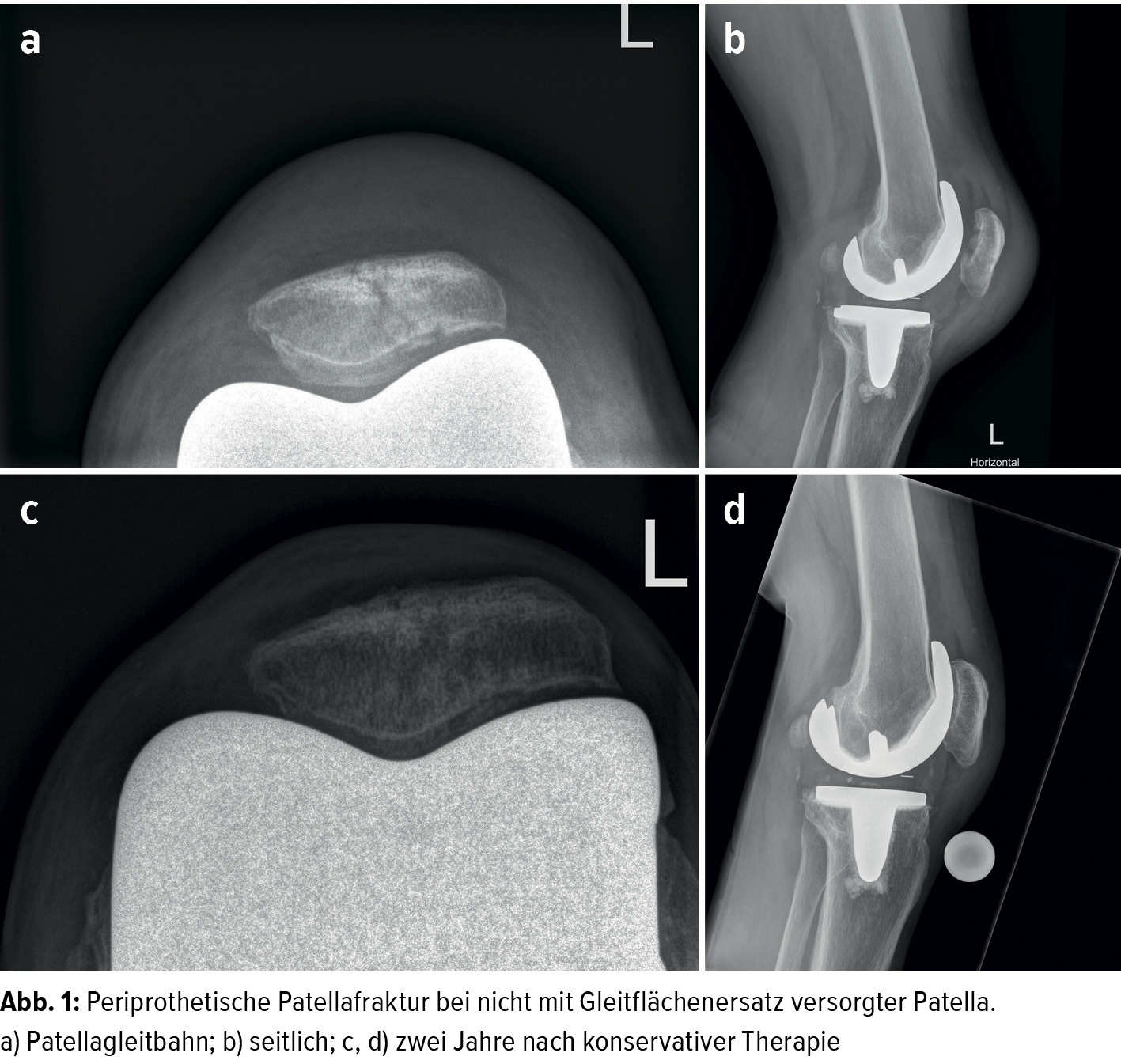 Insuffizienz des Streckapparates nach Knietotalprothese - Orthopdie &  Traumatologie - Universimed - Knowledge that matters