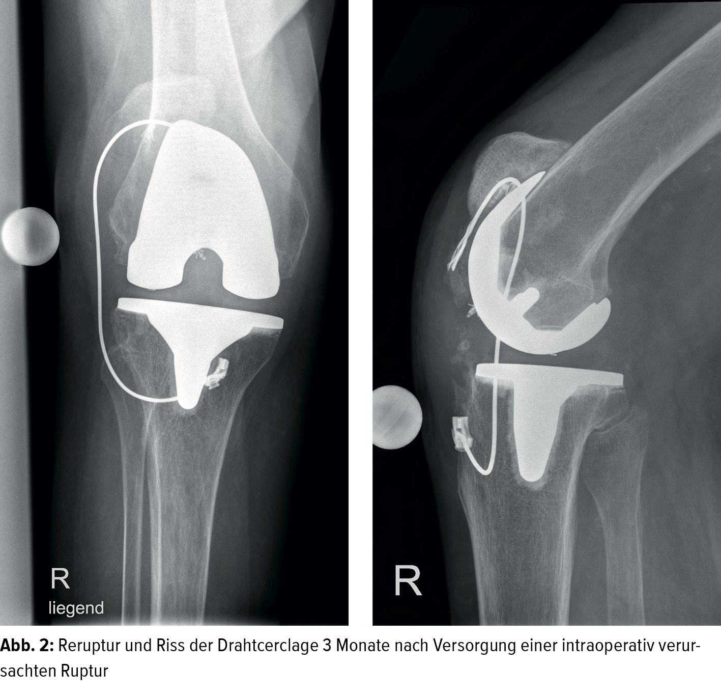 Insuffizienz des Streckapparates nach Knietotalprothese - Orthopdie &  Traumatologie - Universimed - Knowledge that matters