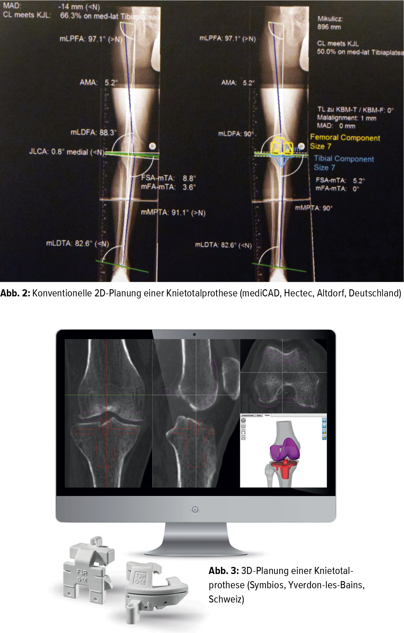 Die Zukunft der Knieprothetik hat schon begonnnen - Orthopdie &  Traumatologie - Universimed - Knowledge that matters