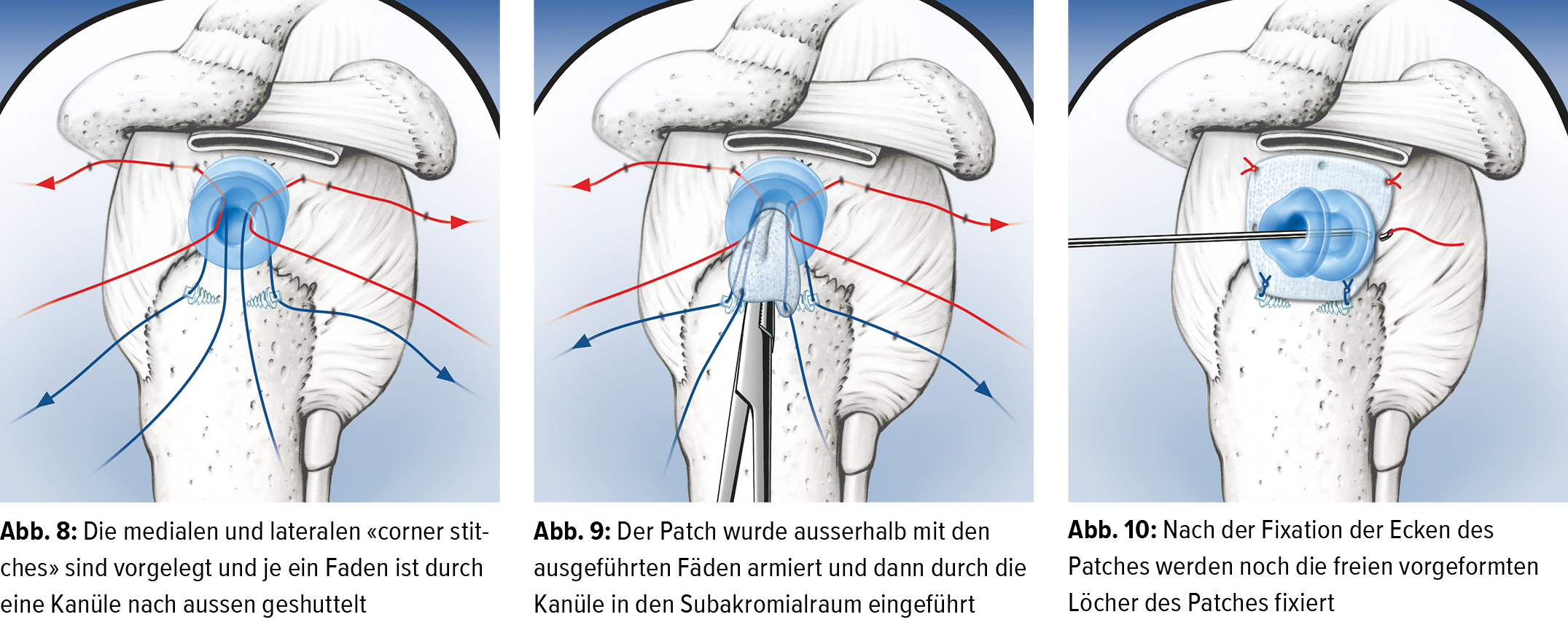Nicht resorbierbare, arthroskopische Patch-Augmentation bei  Rotatorenmanschetten&shy;massenrupturen - Orthopdie & Traumatologie -  Universimed - Knowledge that matters