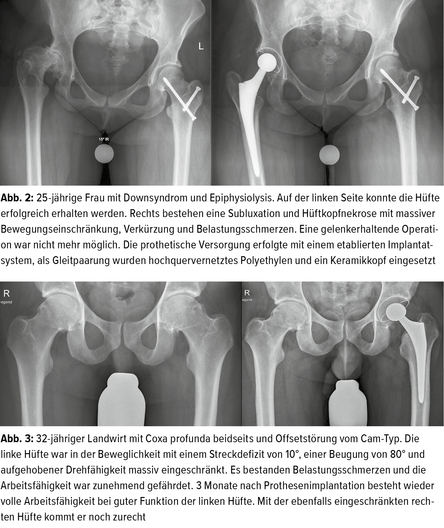 Hftendoprothetik bei jngeren Patienten - Orthopdie & Traumatologie -  Universimed - Knowledge that matters
