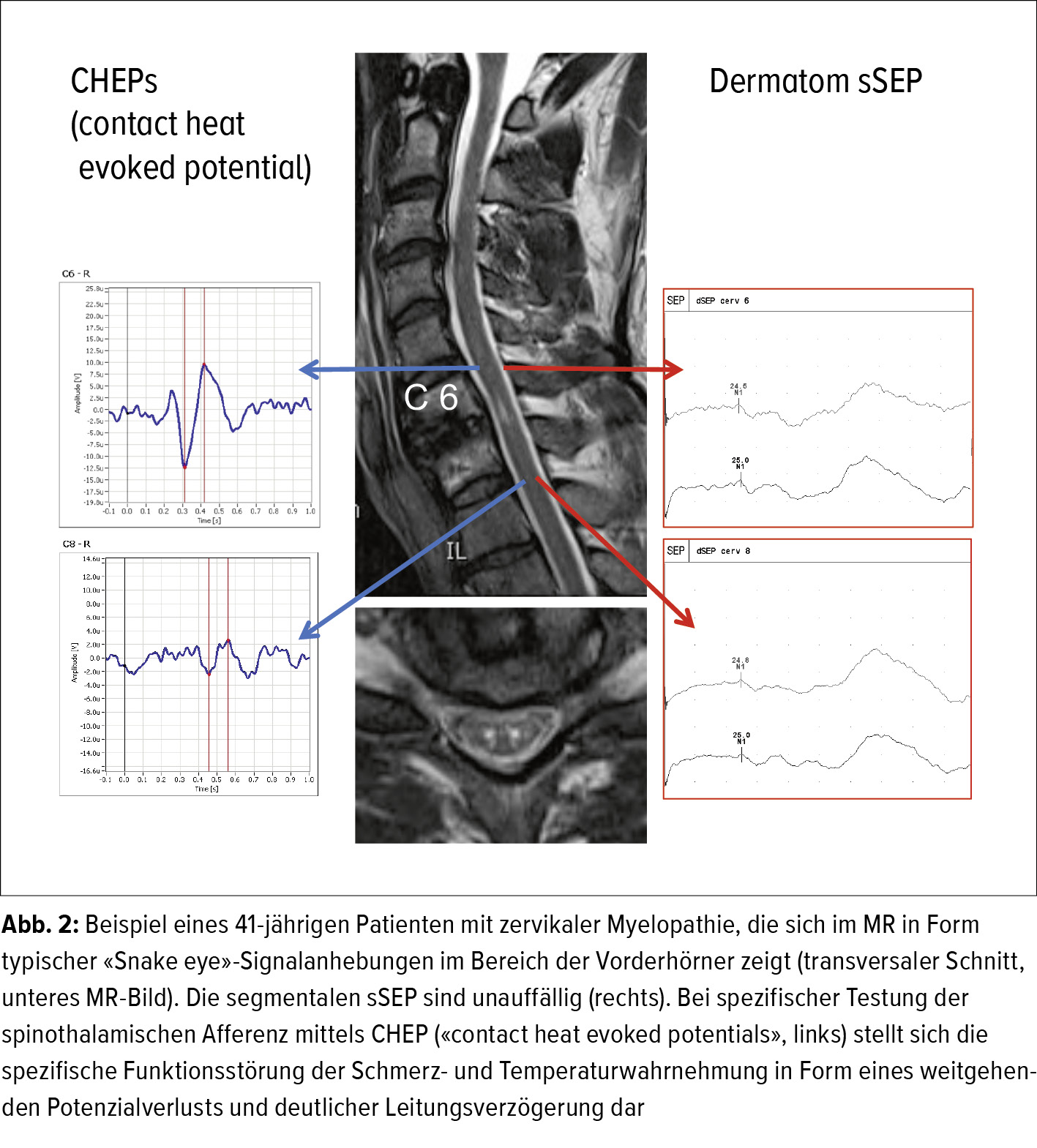 Neurologische Operationsindikation An Der Wirbelsaule Und