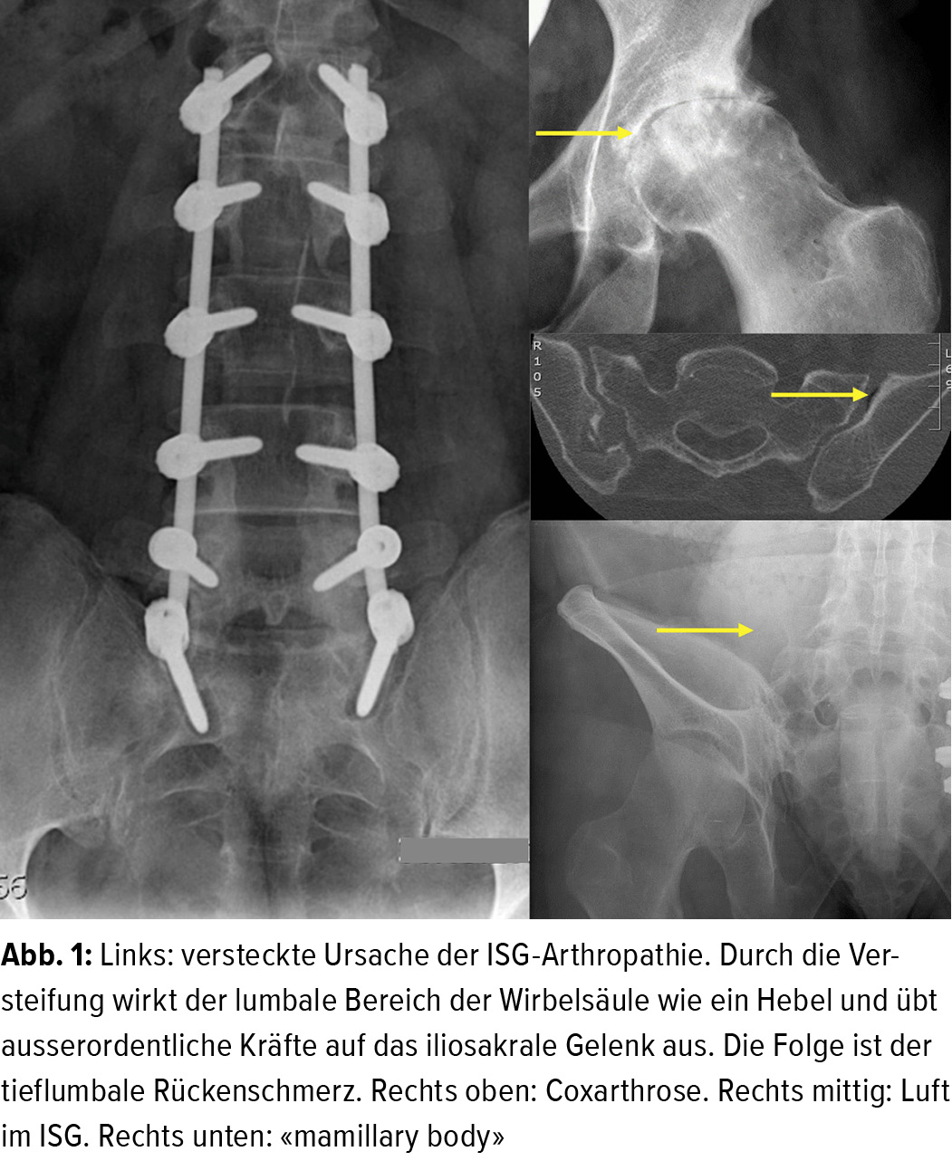 Die Isg Arthropathie Ein Unterdiagnostiziertes Problem Orthopadie Traumatologie Universimed Medizin Im Fokus