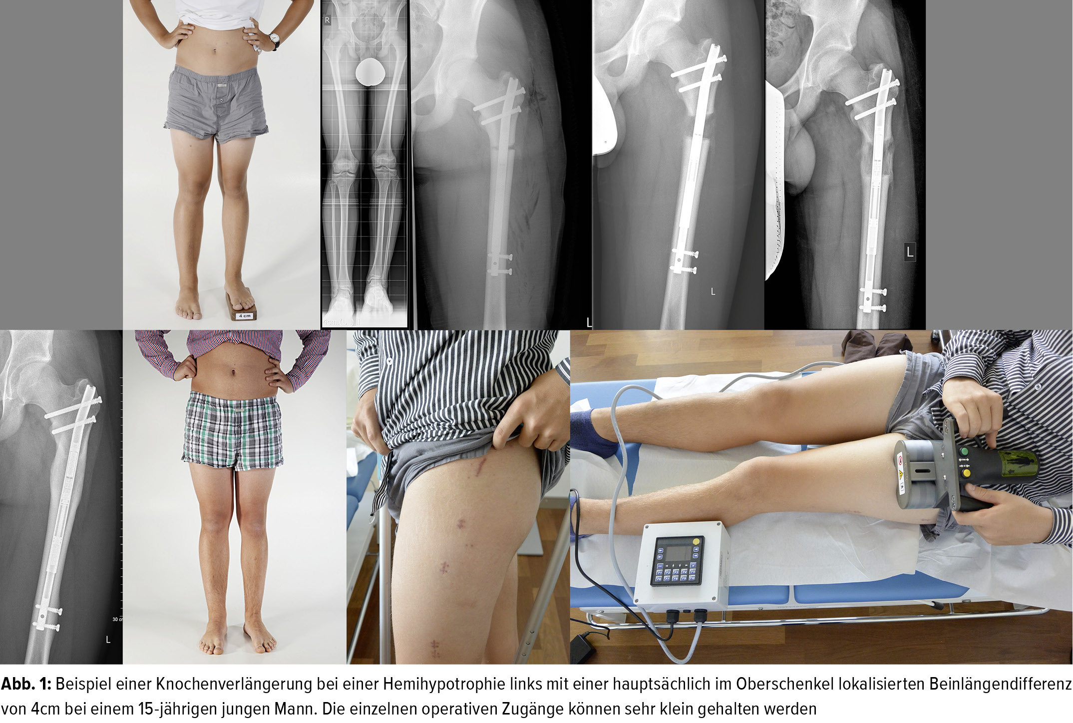 Extremitatenverlangerung Mit Dem Magnetgetriebenen Precice Marknagel Orthopadie Traumatologie Universimed Medizin Im Fokus 