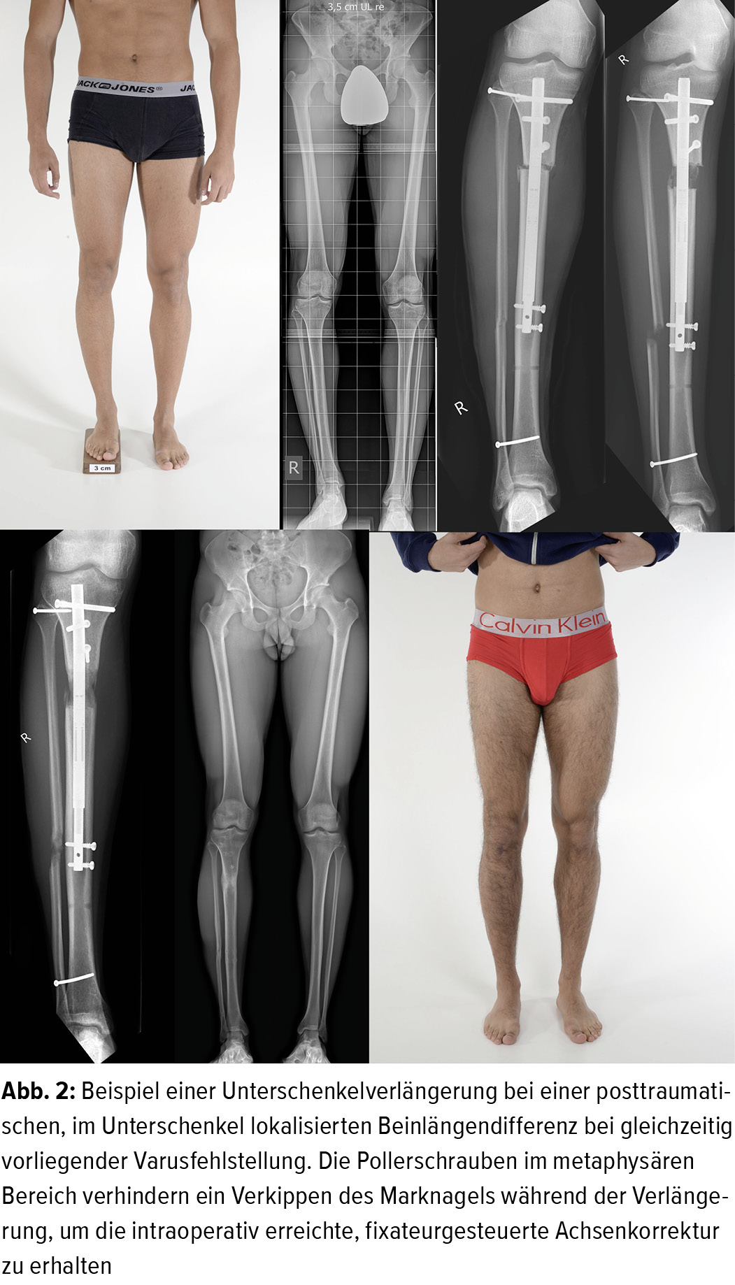 Extremitatenverlangerung Mit Dem Magnetgetriebenen Precice Marknagel Orthopadie Traumatologie Universimed Medizin Im Fokus