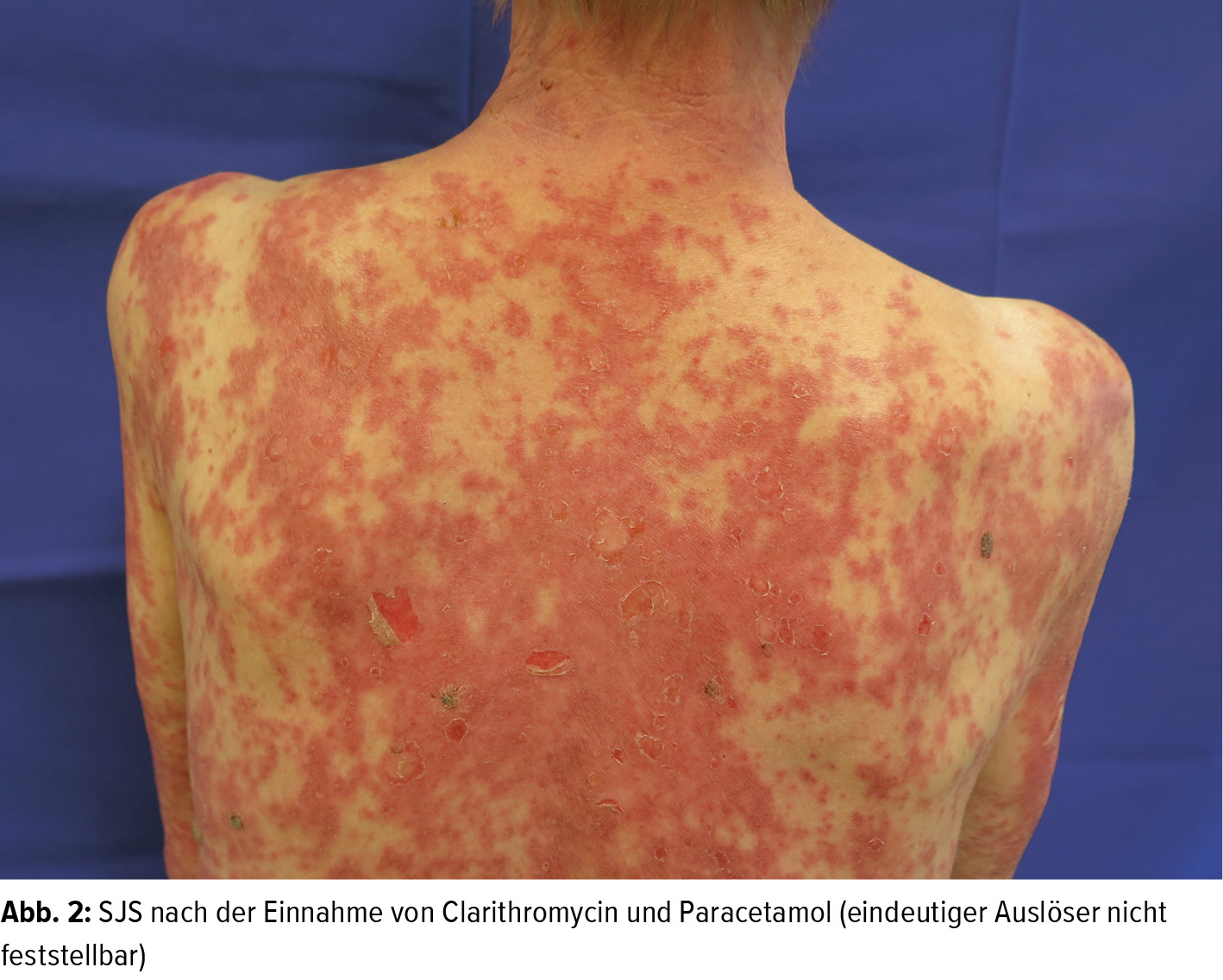 gefahrliche arzneimittelexantheme dermatologie universimed medizin im fokus