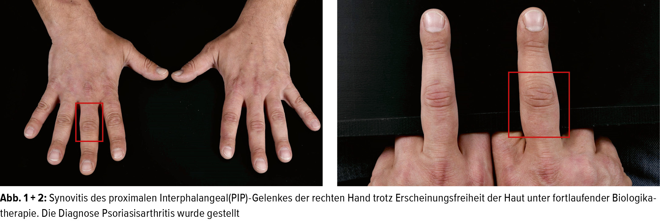 psoriasisarthritis think of it dermatologie universimed medizin im fokus