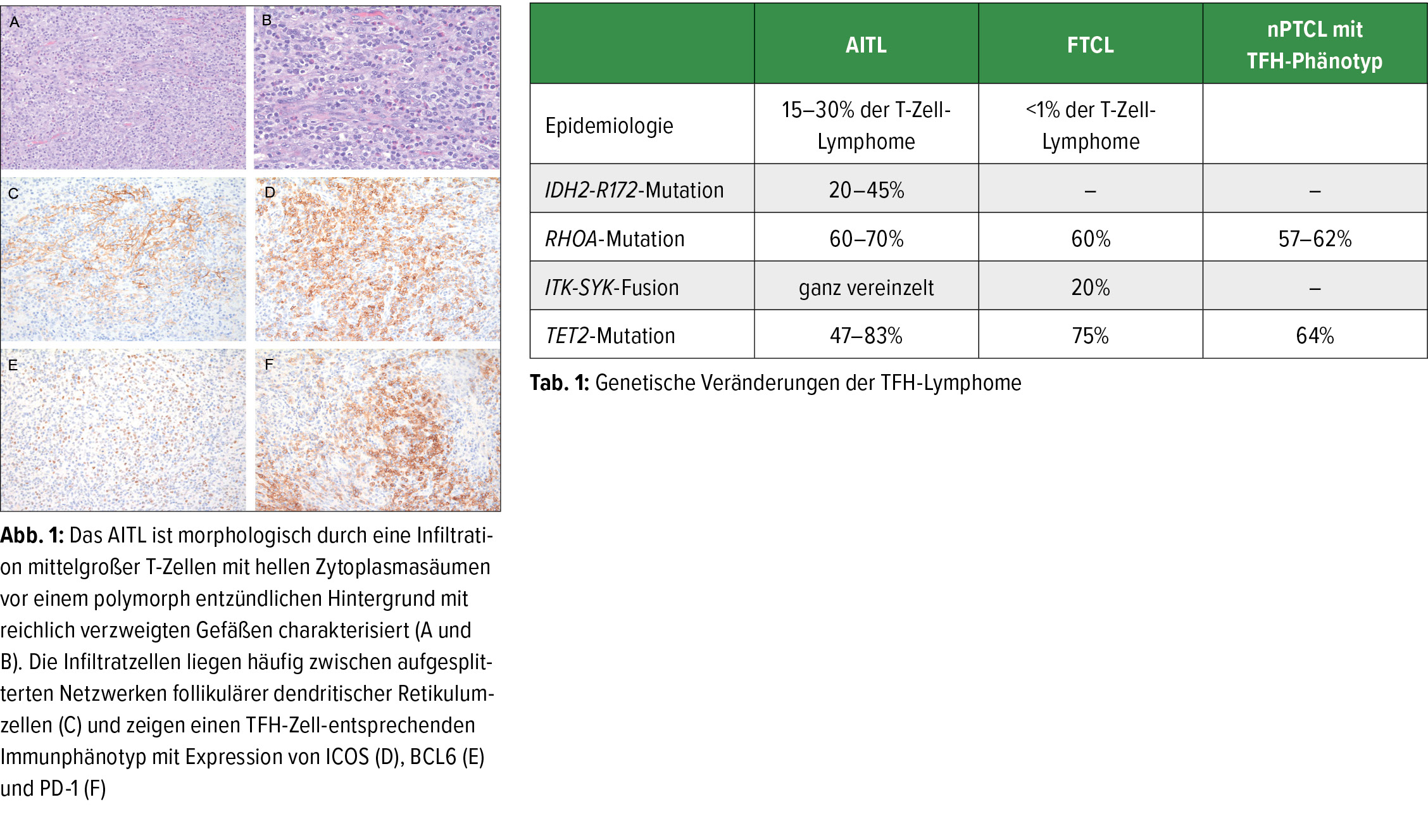 Periphere T Zell Lymphome Mit Tfh Zell Differenzierung Pathologie Universimed Medizin Im Fokus