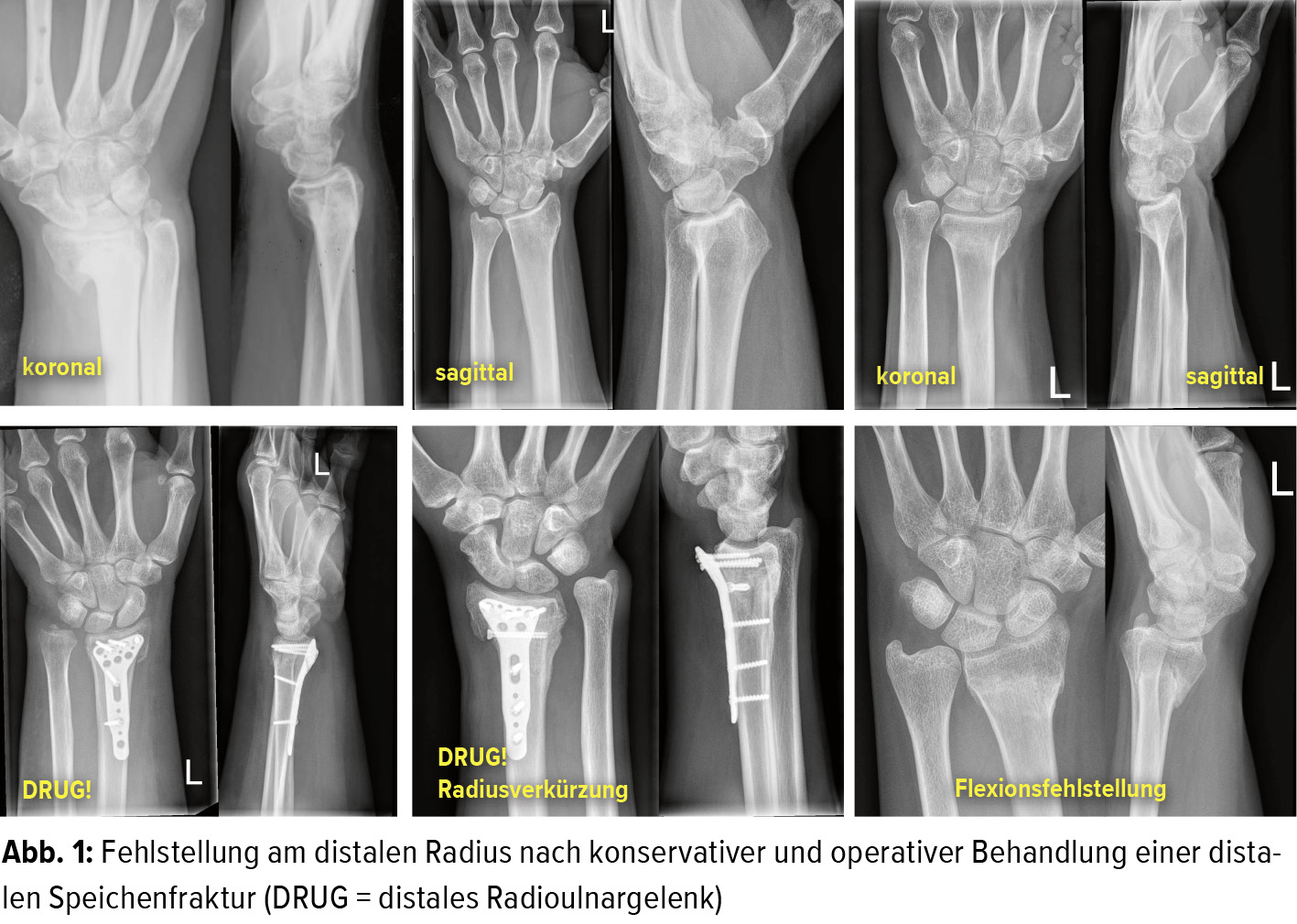 Die Korrekturosteotomie An Der Distalen Speiche Orthopadie Traumatologie Universimed Medizin Im Fokus