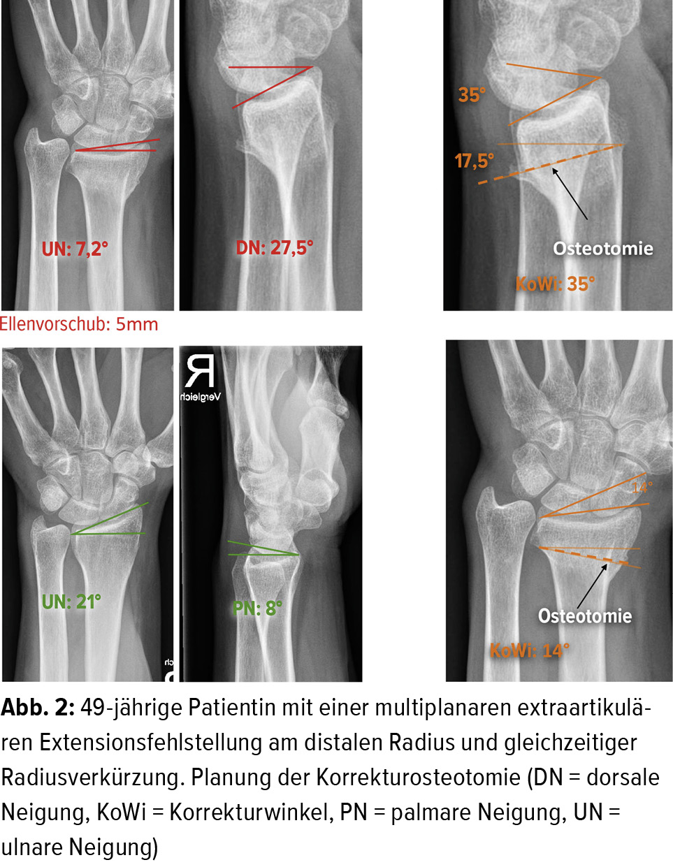 Die Korrekturosteotomie An Der Distalen Speiche Orthopadie Traumatologie Universimed Medizin Im Fokus