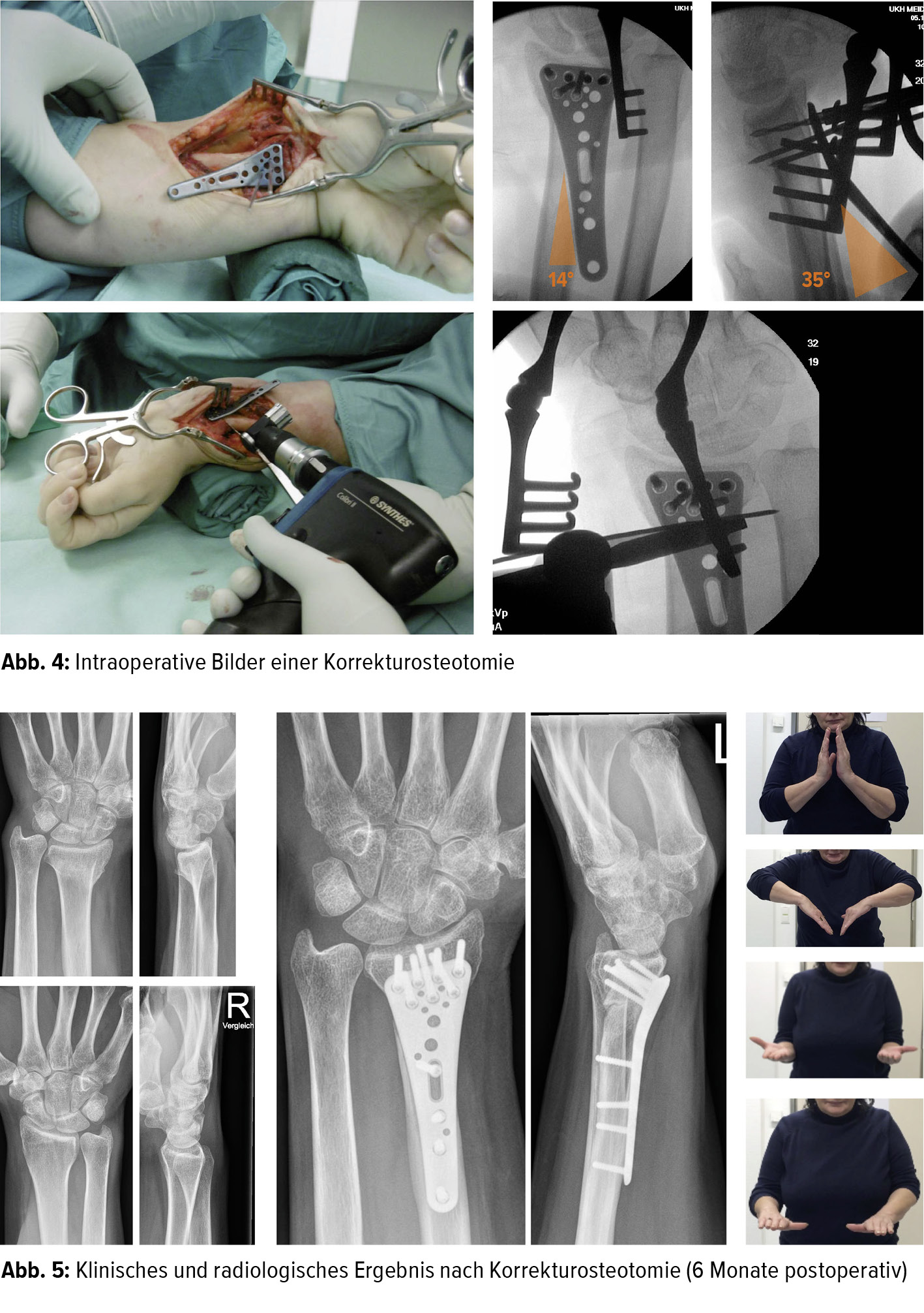 Die Korrekturosteotomie An Der Distalen Speiche Orthopadie Traumatologie Universimed Medizin Im Fokus