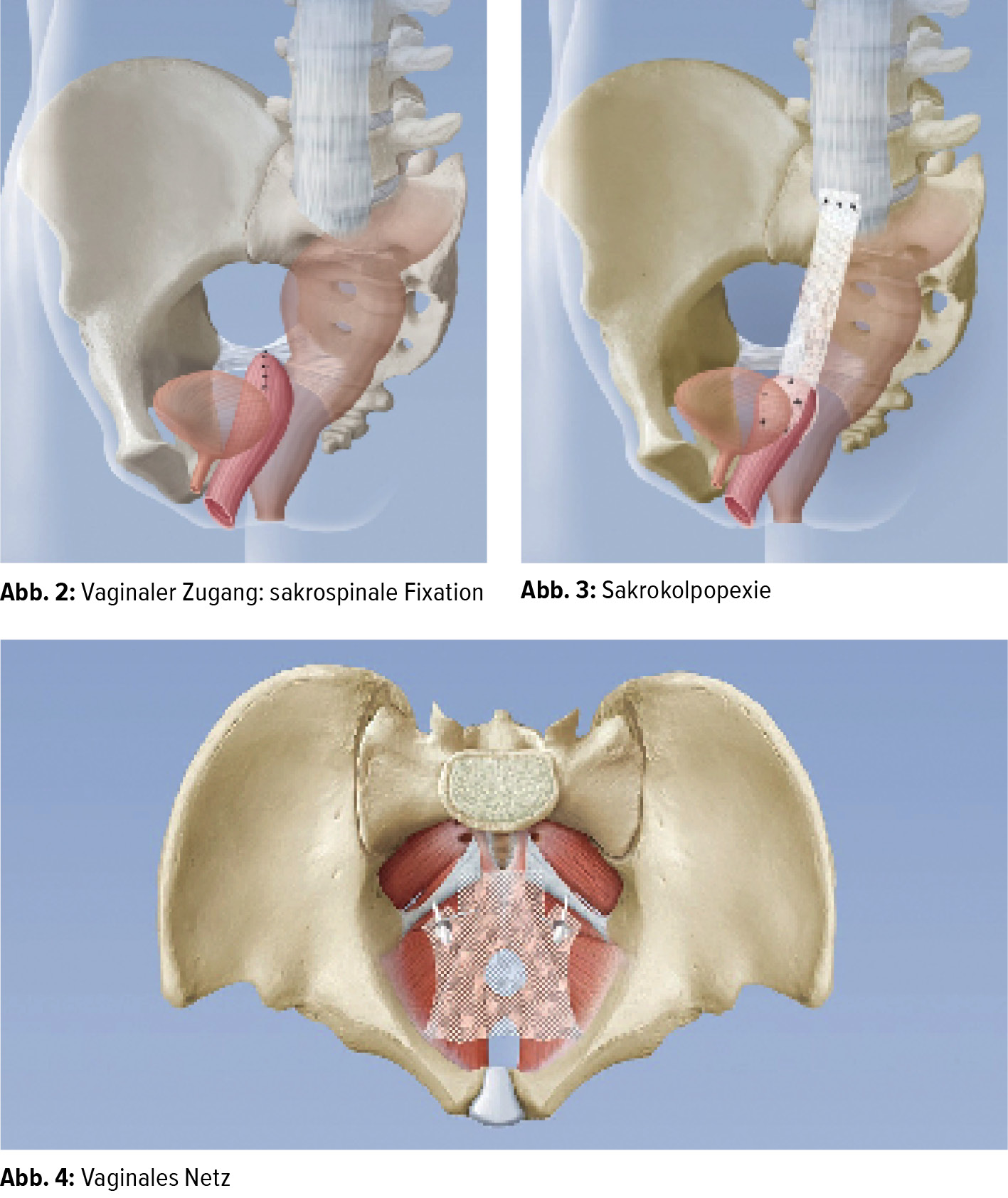 Der Urogenitale Deszensus Ein Globales Gesundheitsproblem Gynakologie Geburtshilfe Universimed Medizin Im Fokus