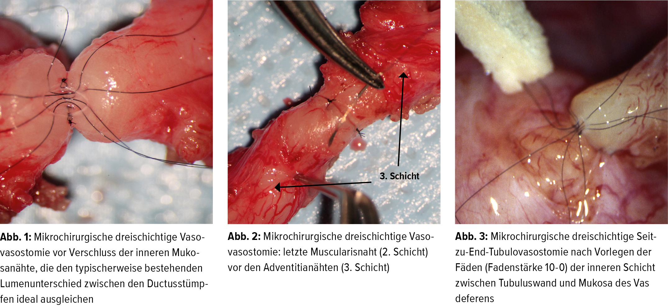 Die mikrochirurgische Refertilisierung - Urologie & Andrologie -  Universimed - Knowledge that matters