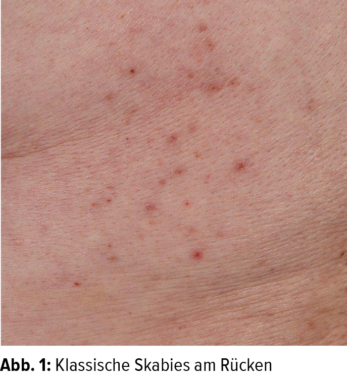 Pitfalls im Skabiesmanagement Dermatologie Universimed Medizin im Fokus