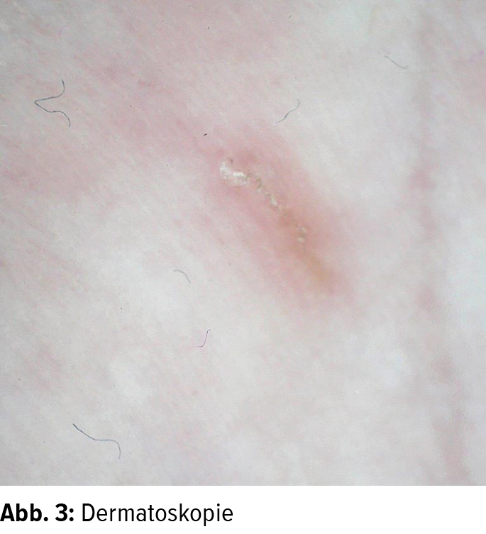 Pitfalls im Skabiesmanagement Dermatologie Universimed Medizin im Fokus