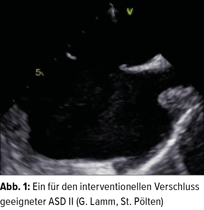 ASD und PFOVerschluss Update 2019 Kardiologie & Gefäßmedizin Universimed Medizin im Fokus