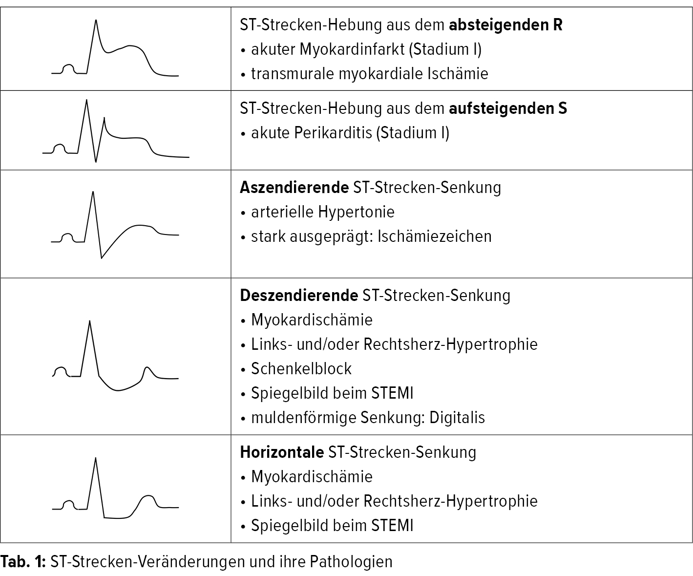 Endstreckenveranderungen Im Ruhe Ekg Kardiologie Gefassmedizin Universimed Medizin Im Fokus