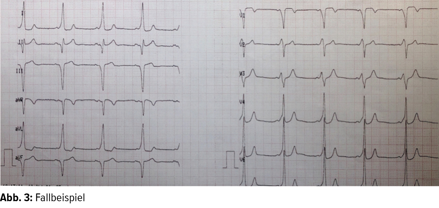 antidrome wpw 12 Kanal EKG