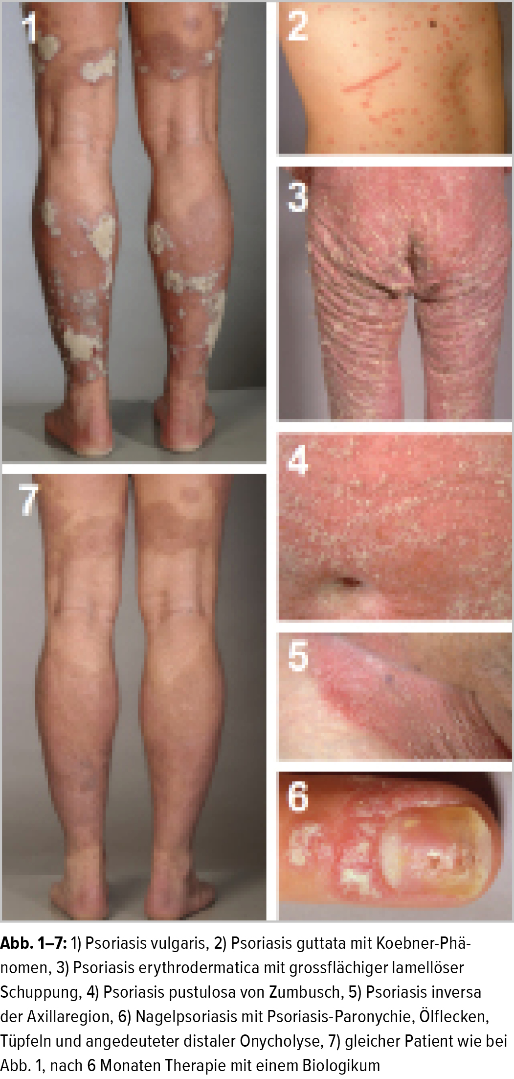 psoriasis guttata therapie