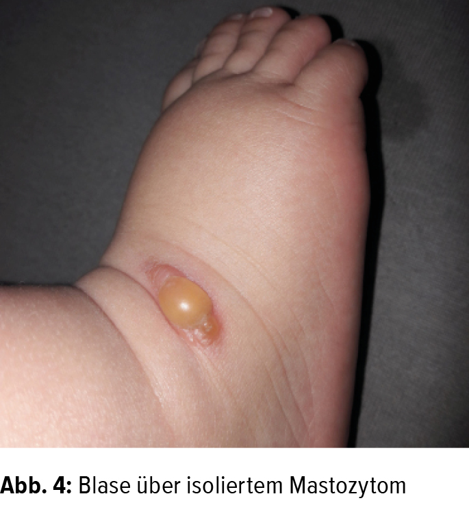 Blasenbildende Dermatosen Im Kindesalter Dermatologie Universimed Medizin Im Fokus