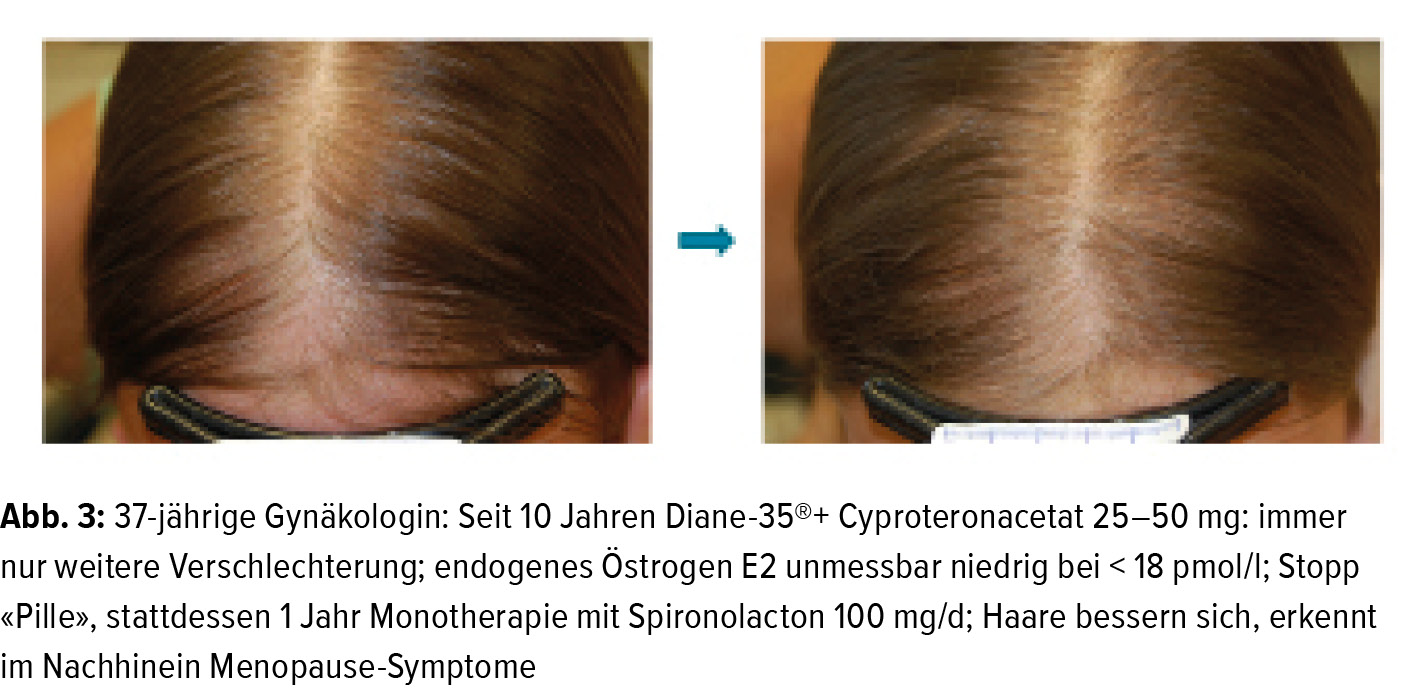 Therapie über Minoxidil hinaus - Dermatologie - Universimed - Medizin im  Fokus