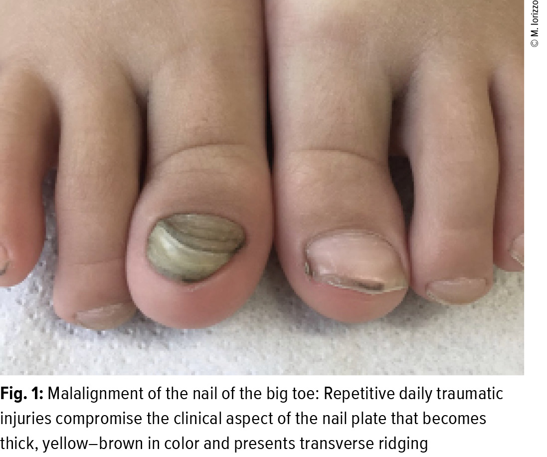 Figure 1 from Psoriatic arthritis and nail changes: exploring the  relationship. | Semantic Scholar