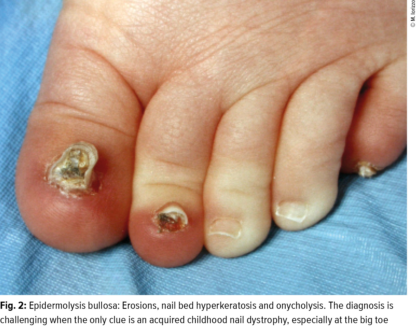 Genetics of human isolated hereditary nail disorders  Khan  2015   British Journal of Dermatology  Wiley Online Library