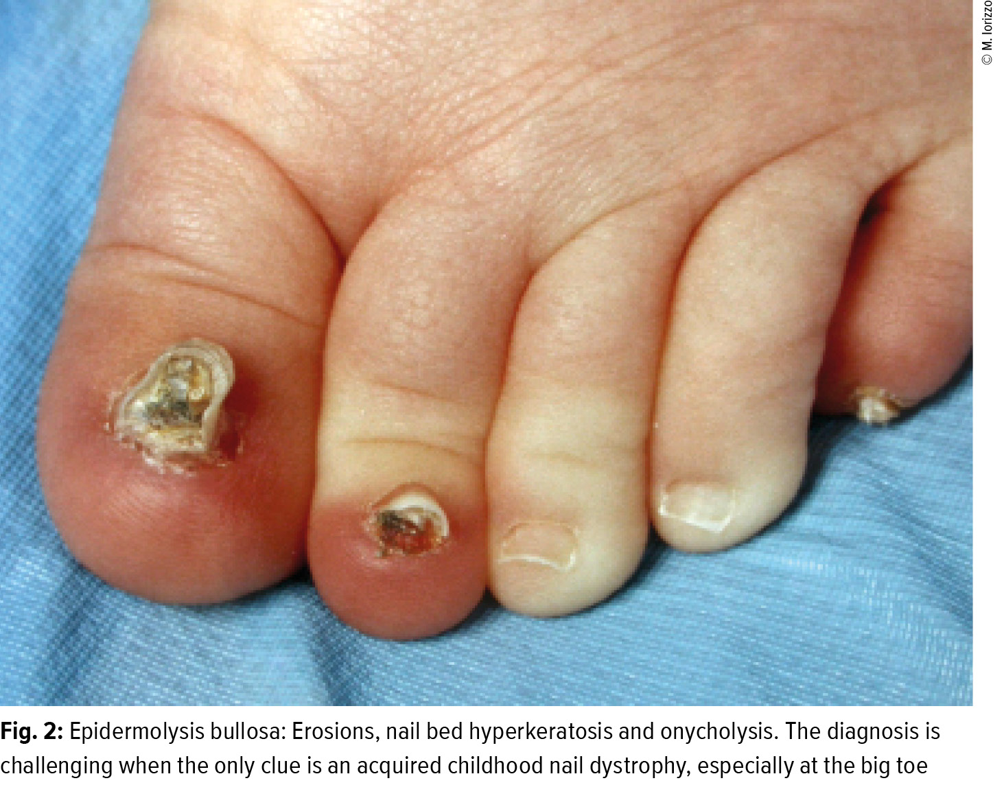 Current Concepts In Treating Psoriatic Nails