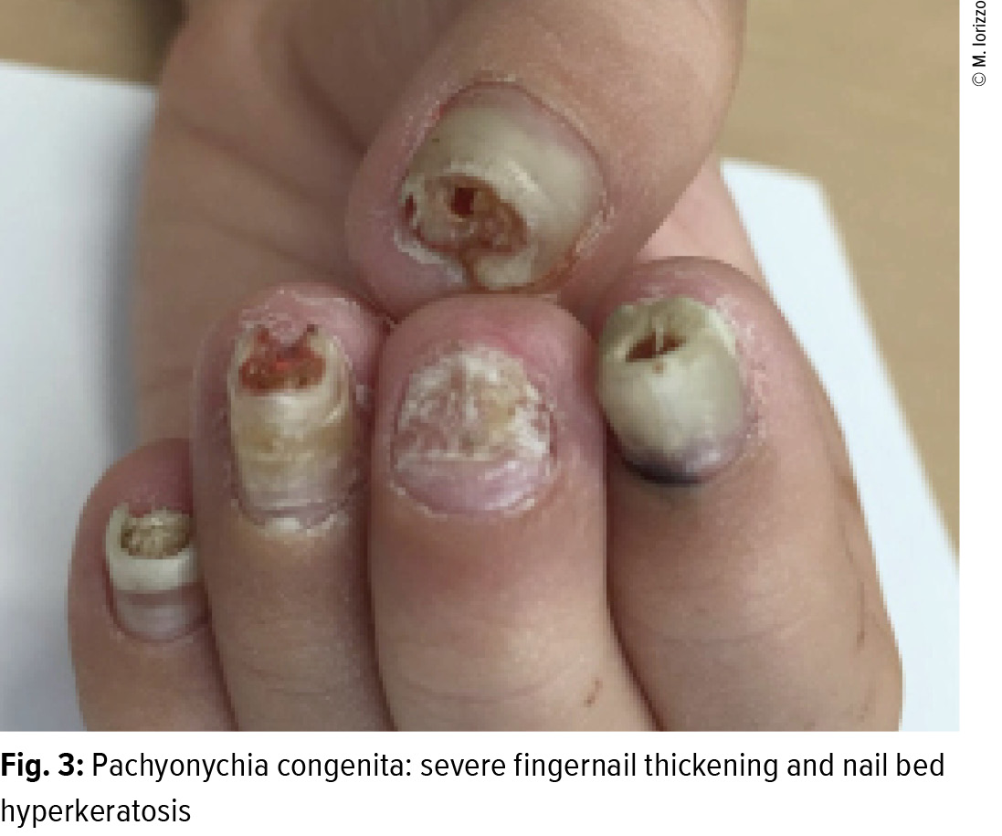 Proposing an Algorithm to Treat Dystrophic Toenails | Podiatry Today
