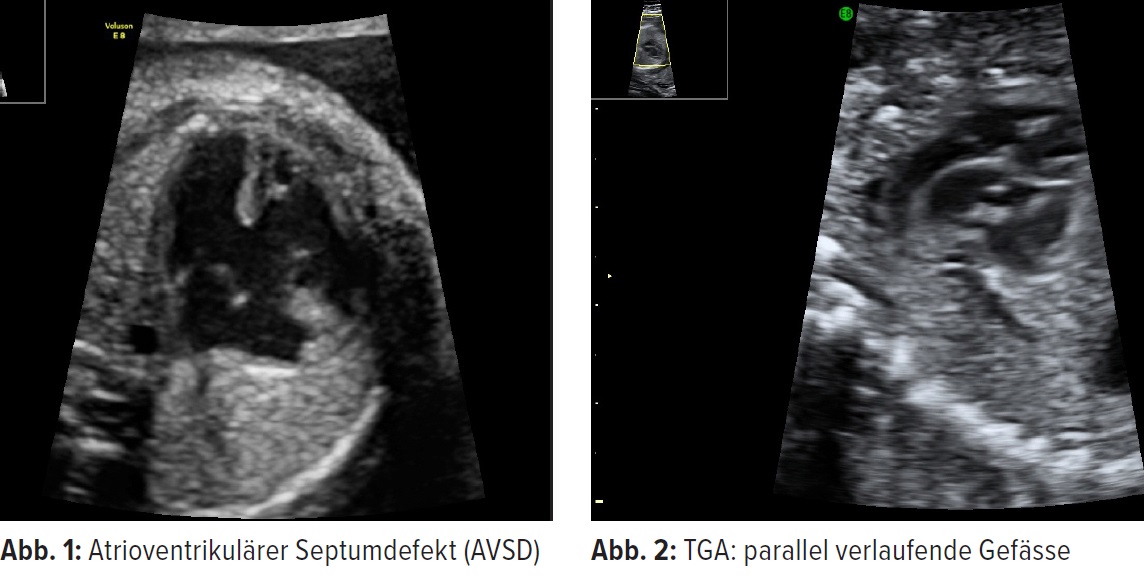 Fetale Herzfehler Vier Beispiele Gynakologie Geburtshilfe Universimed Medizin Im Fokus
