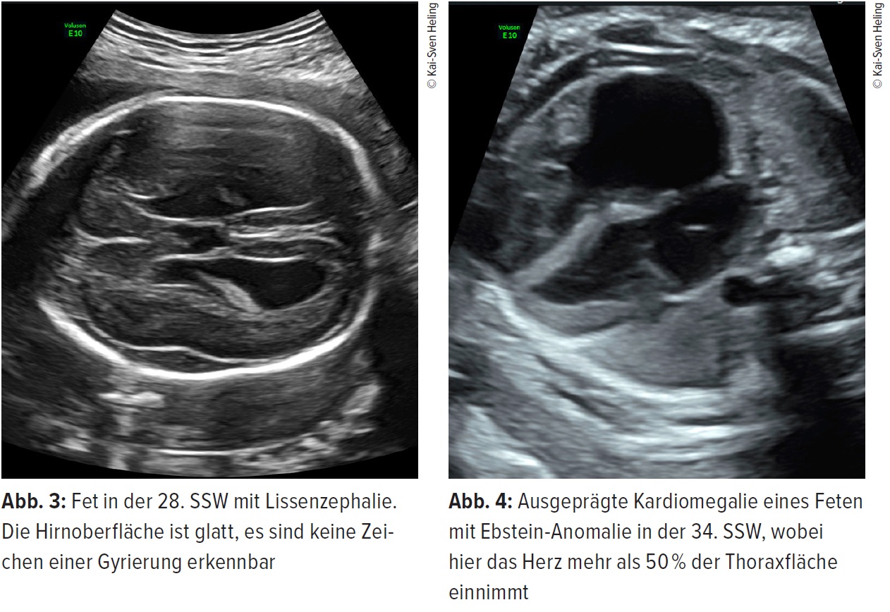 Ultraschall Mit 30 Bis 32 Schwangerschaftswochen Gynakologie Geburtshilfe Universimed Medizin Im Fokus