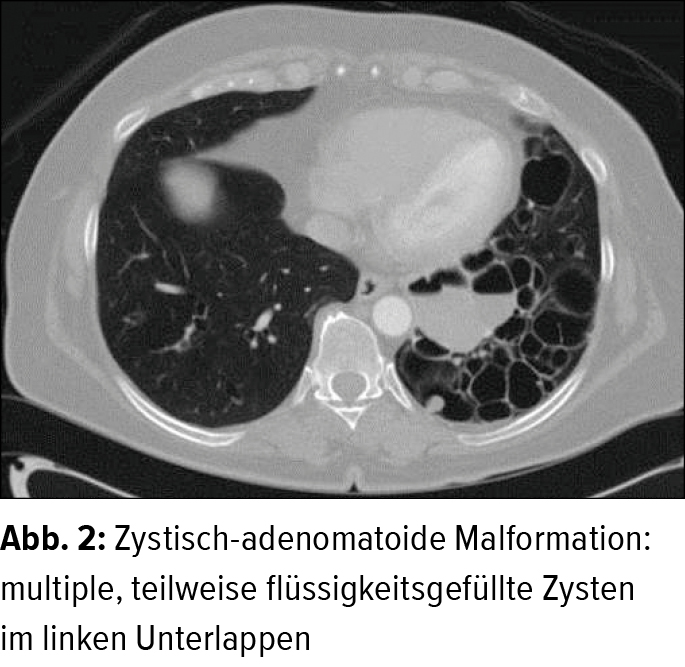 Kongenitale Malformationen Der Lunge Beim Erwachsenen Pneumologie Universimed Medizin Im Fokus