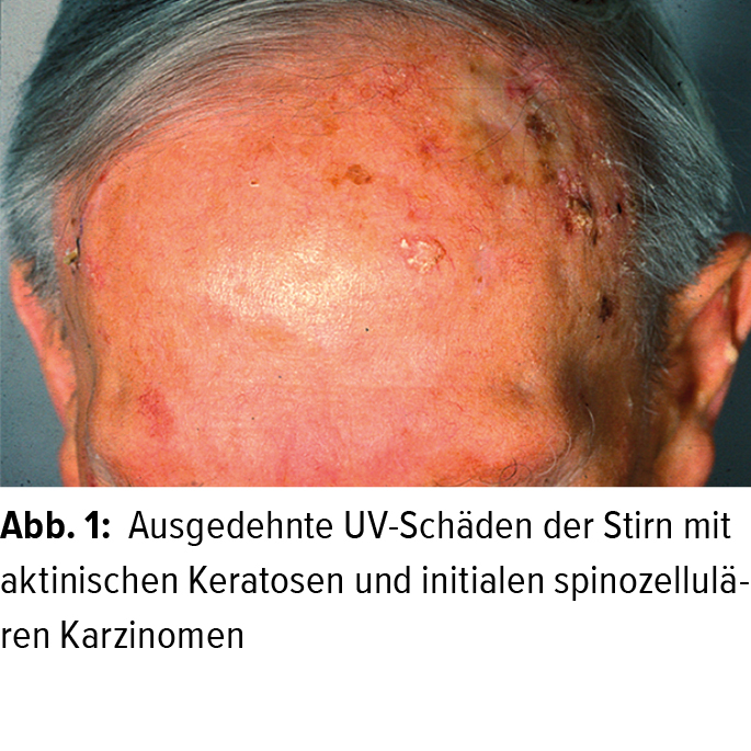 Hautkrebsbehandlung In Der Hausarztpraxis Dermatologie Universimed Medizin Im Fokus