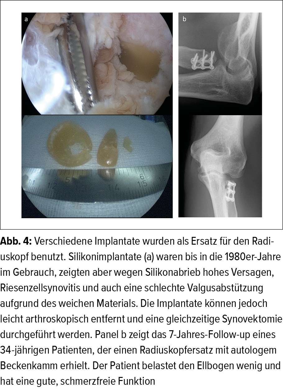 Die chirurgische Behandlung der Ellbogenarthrose - Orthopdie &  Traumatologie - Universimed - Knowledge that matters