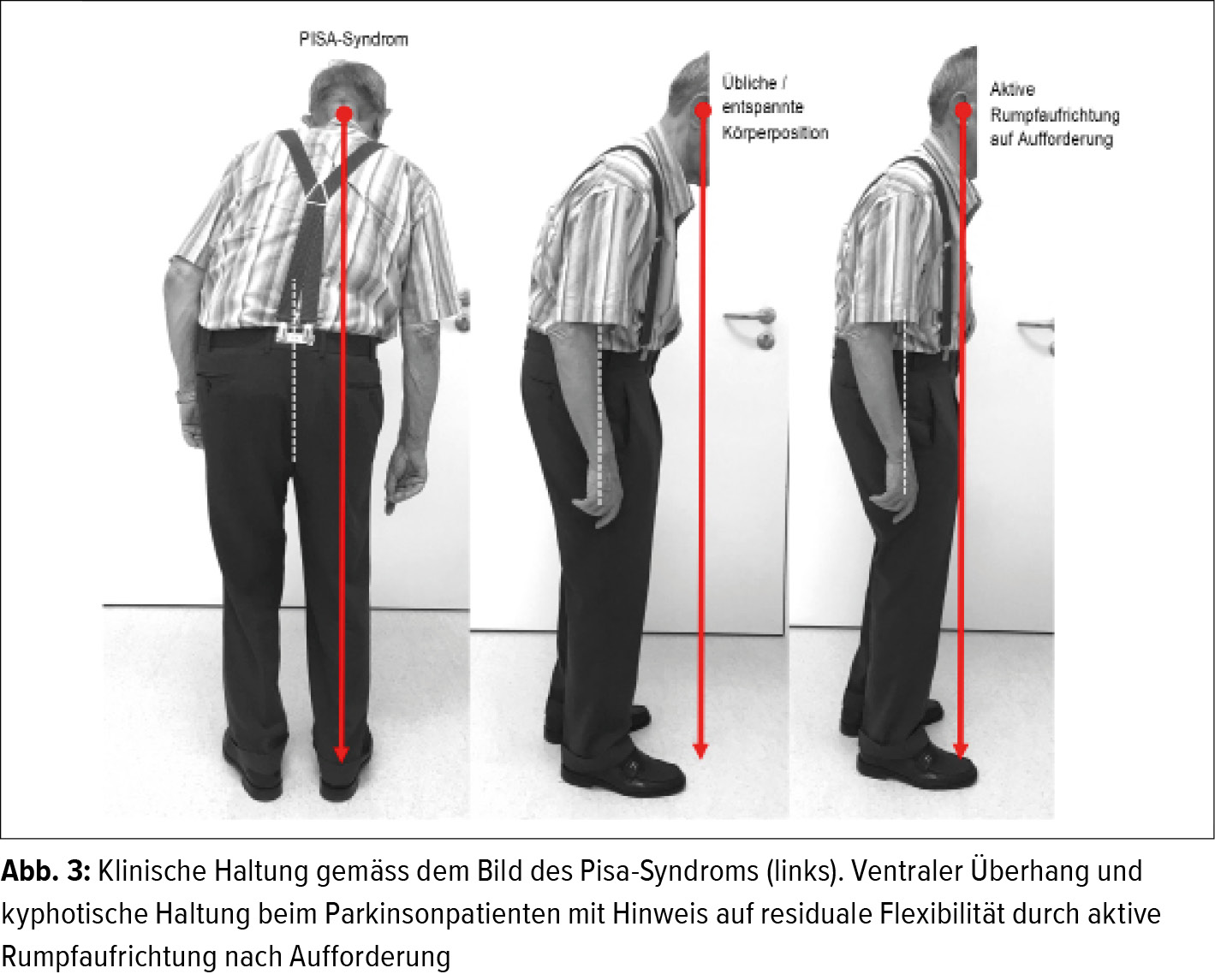 Die Wirbelsäule beim an Parkinson erkrankten älteren Menschen - Orthopädie  & Traumatologie - Universimed - Medizin im Fokus