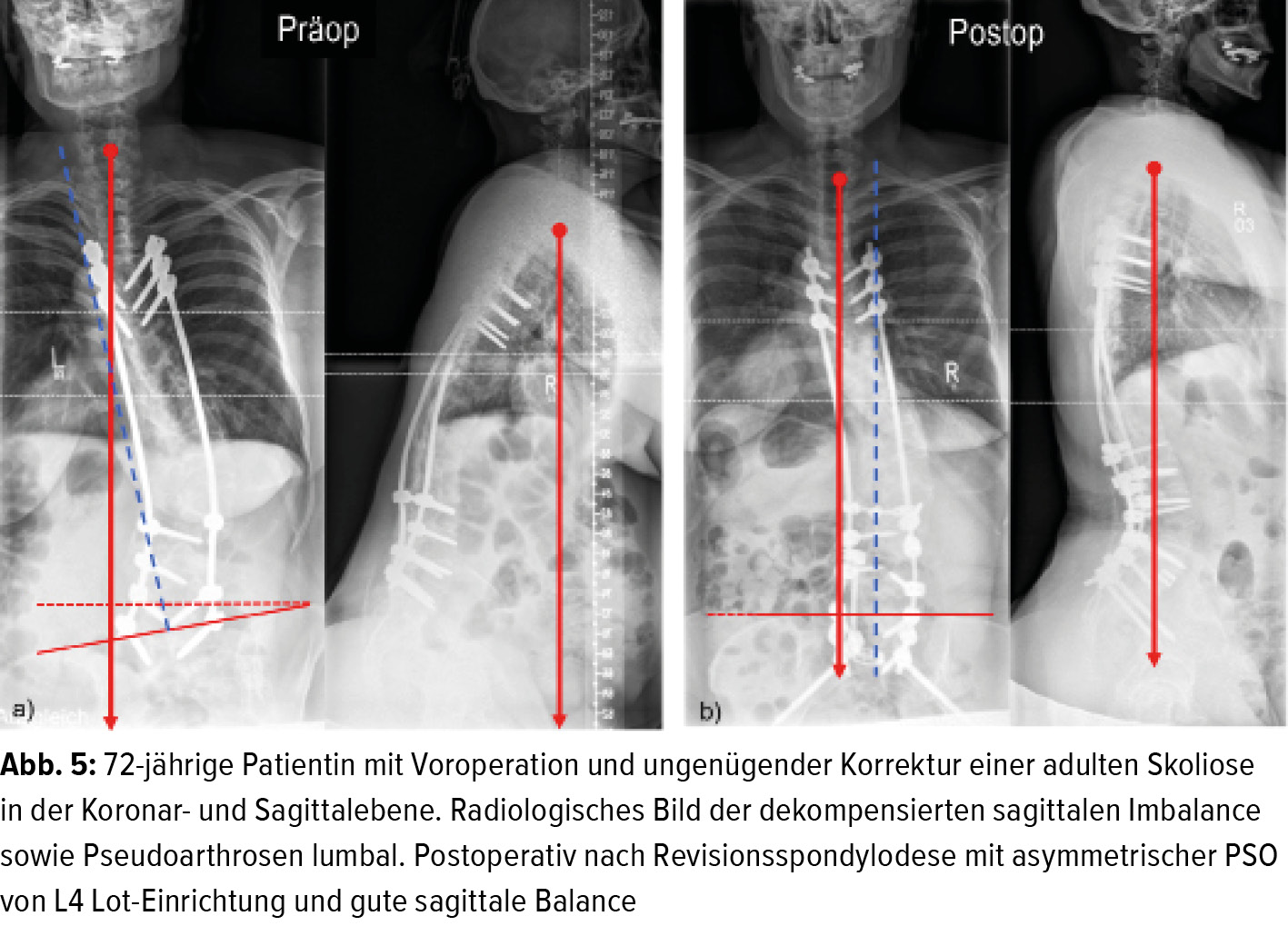 Die Wirbelsäule beim an Parkinson erkrankten älteren Menschen - Orthopädie  & Traumatologie - Universimed - Medizin im Fokus